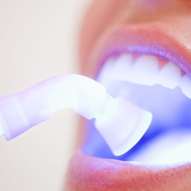 Dudas habituales sobre el blanqueamiento dental