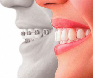 Nuevos tipos de ortodoncia