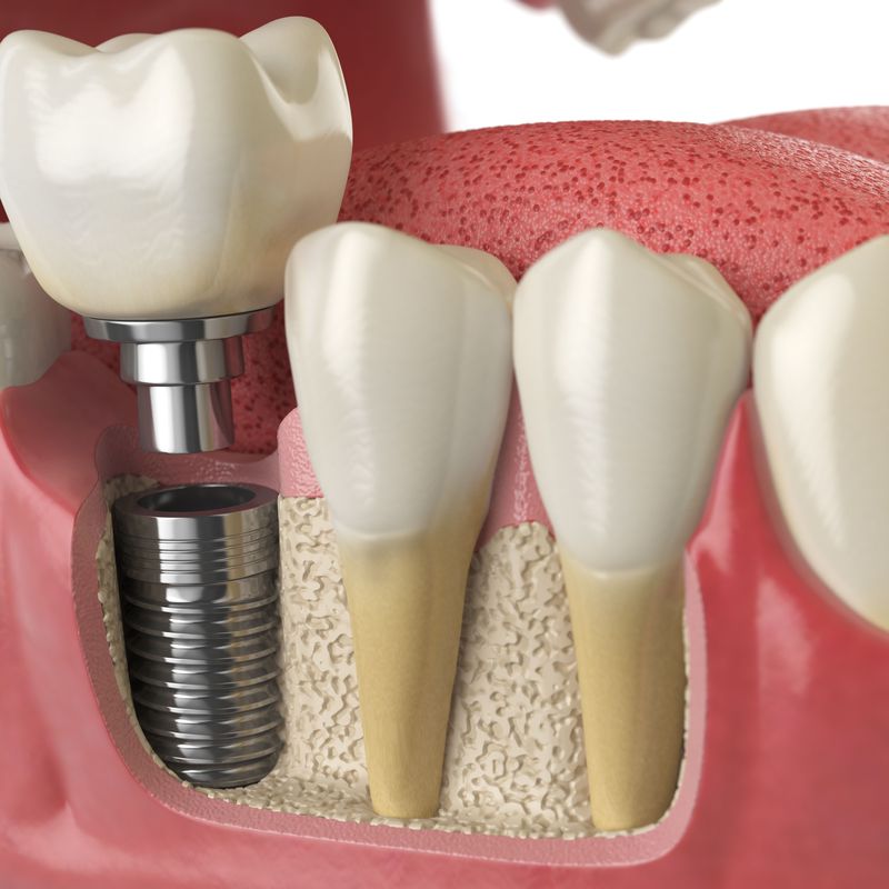 Implantología: Diagnóstico y prevención de Clínica Dental Doctoras Álvarez y Frutos