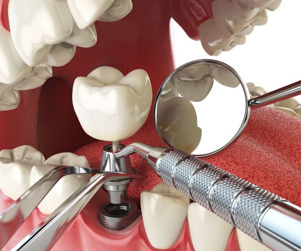 ¿Conoces las ventajas de los implantes dentales?