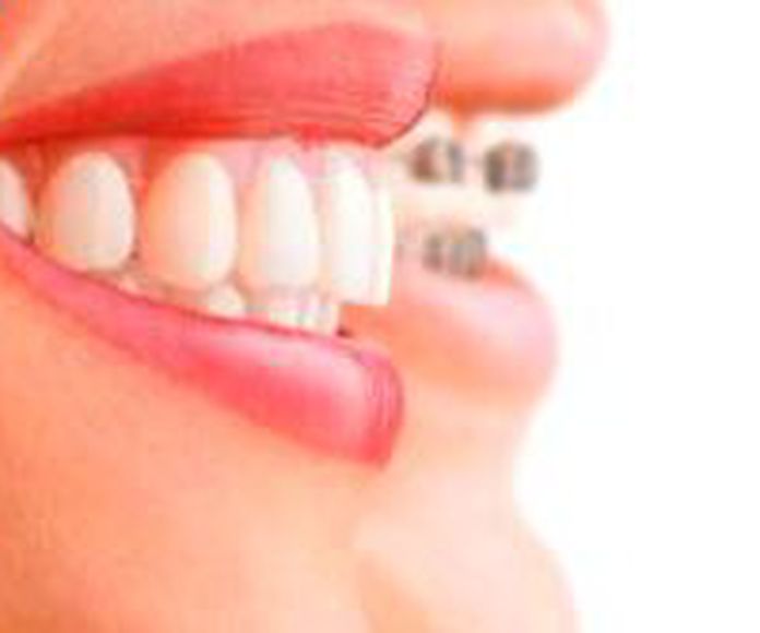 Ortodoncia: Tratamientos de Dental Clínic Palamós