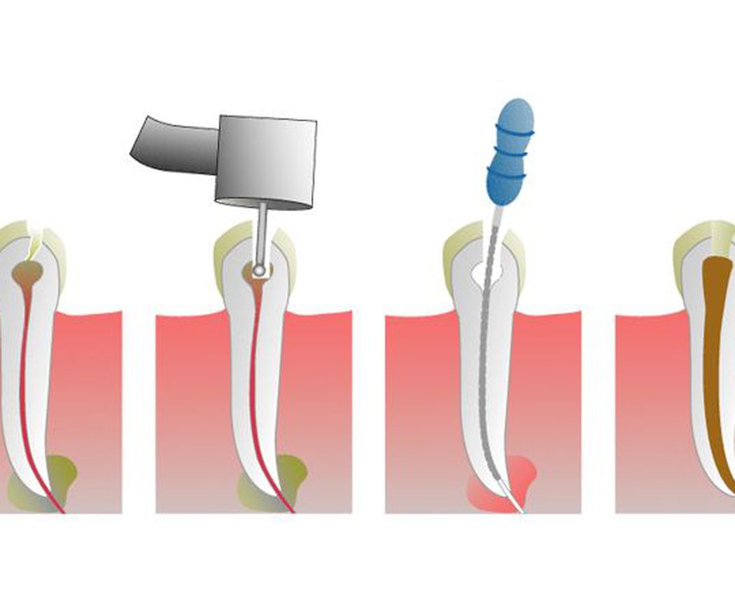 La endodoncia
