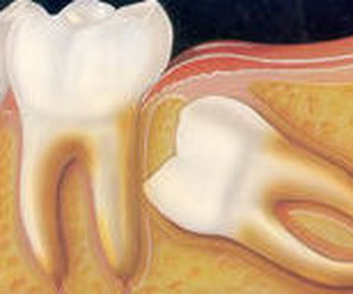 Cirugía dental: Tratamientos de Clínica Dental Fortaña-Giménez }}
