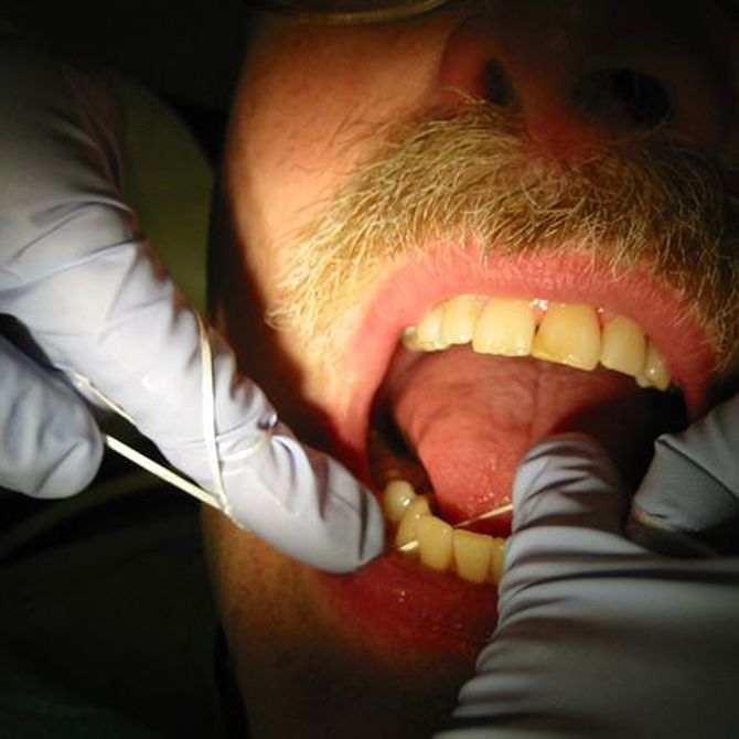 El hilo dental, compatible con la ortodoncia invisible
