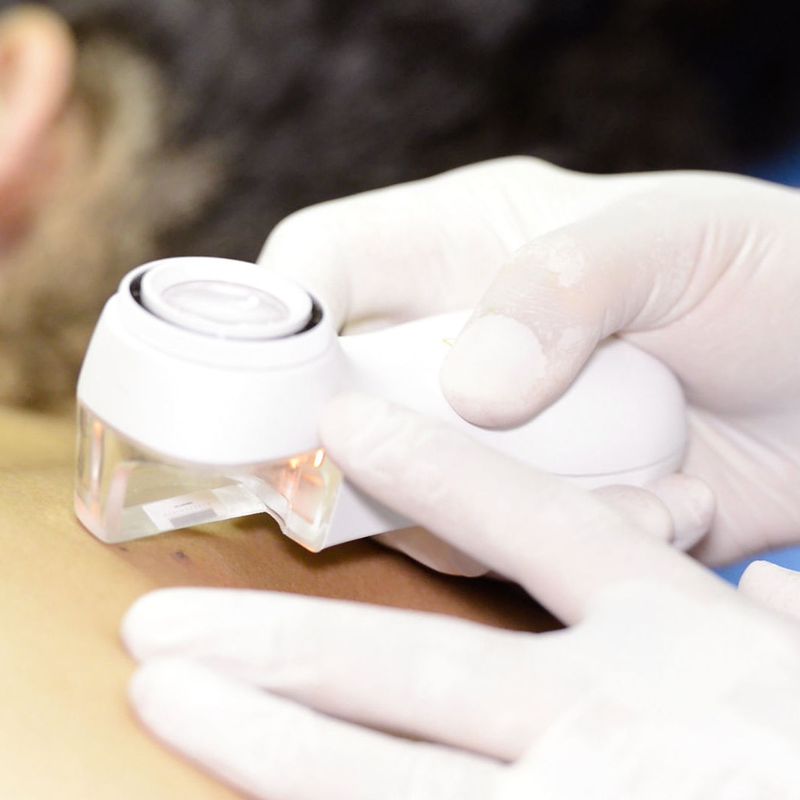 Cánceres no melanoma: Dermatología y Dermoestética de Dermatología Socorro Fierro