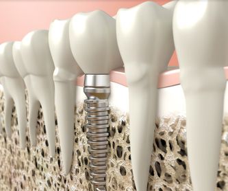 Prótesis dental: SERVICIOS de Altes Dental