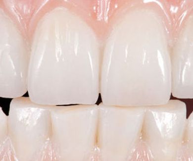 Estética Dental - Protesis Fija Zirconio Monolitico