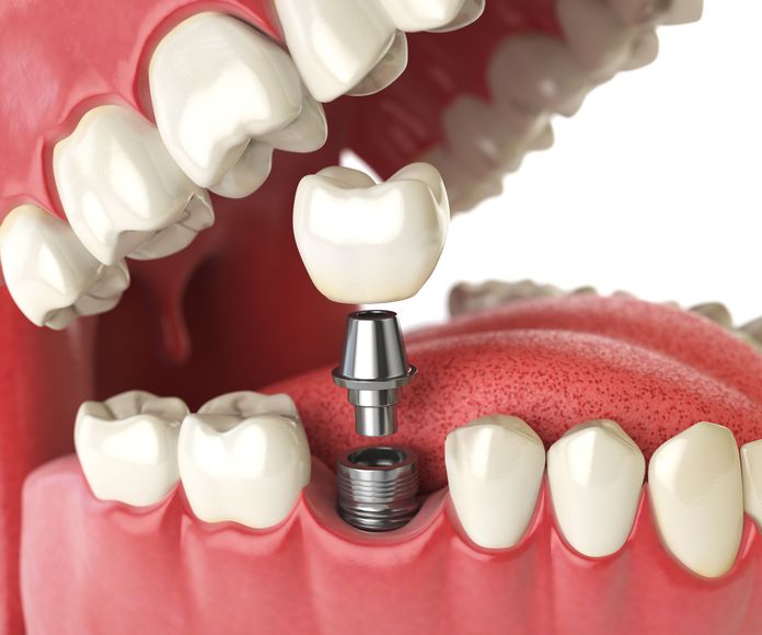 Colocación de implantes con poco hueso: Tratamientos de Clínica dental Vall Hebrón