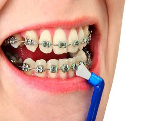 Consejos para limpiarte los dientes con ortodoncia