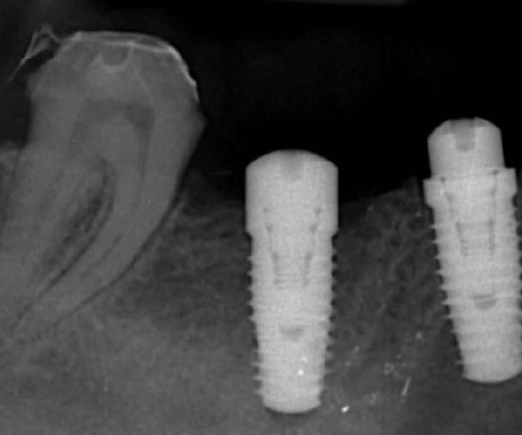 ¿Para qué se usa un implante dental?