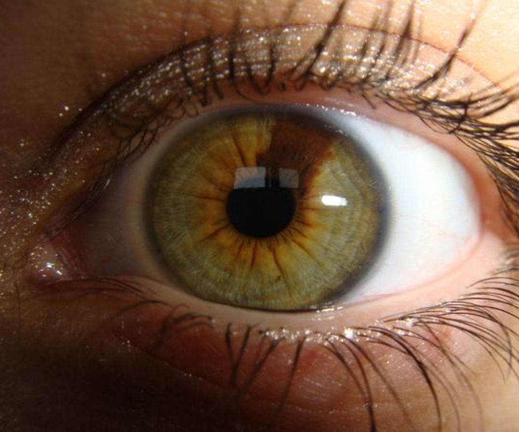 ¿Qué clases de glaucoma existen?