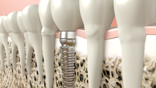 Imagen de SERVICIOS - Implantes