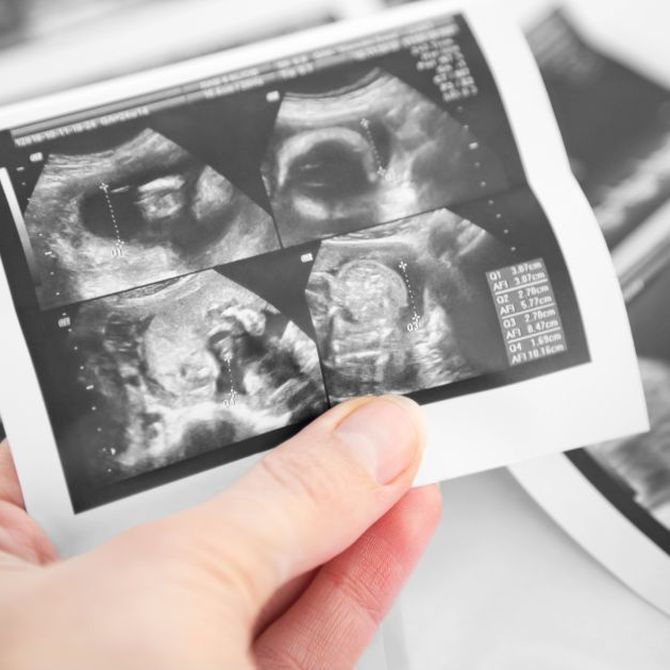 ¿Cuántas ecografías se hacen durante un embarazo?
