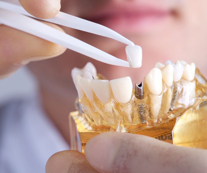 Prótesis: Servicios de Clínica Dental Irudent
