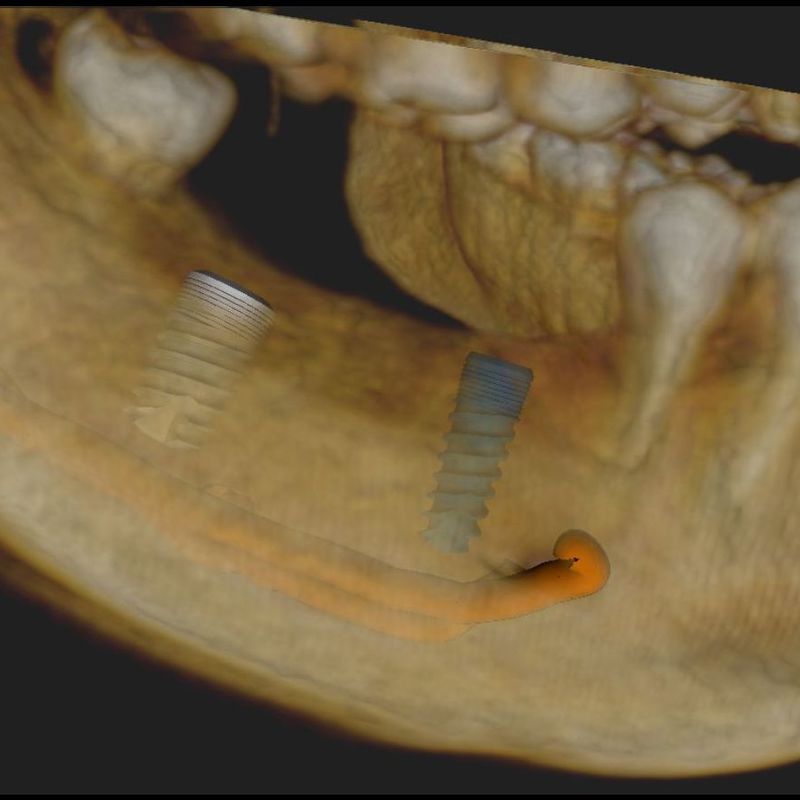 Implantes  : Servicios   de Clínica Dental Dr. Javier Pérez Martínez N.I.C.A. 27795