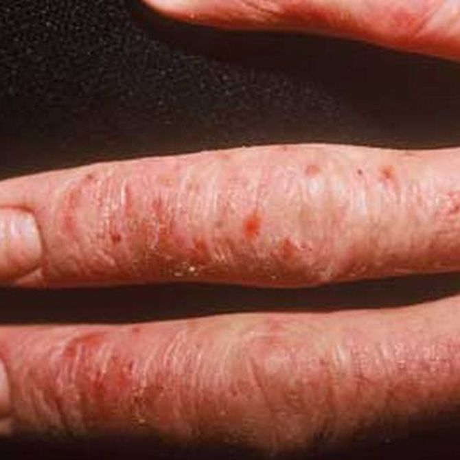 ¿Por qué se producen la alergias en la piel?