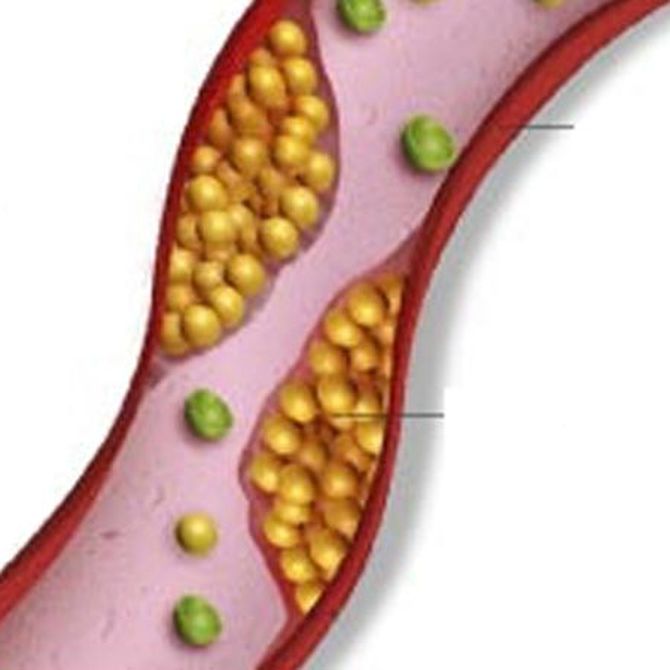 Riesgos de tener niveles altos de colesterol en sangre