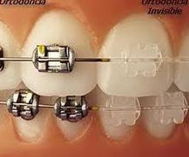 ¿Ortodoncia fija o removible?