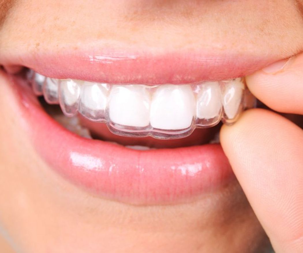 Descubre todas las ventajas de la ortodoncia invisible Invisalign