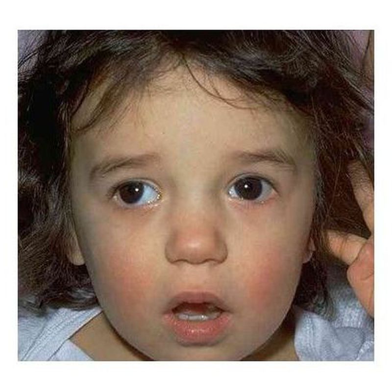 Oftalmología infantil: Patologías oculares de Oftalmólogo Cristina Mantolán Sarmiento