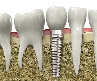 Odontología conservadora: Tratamientos de Clínica Dental Quart