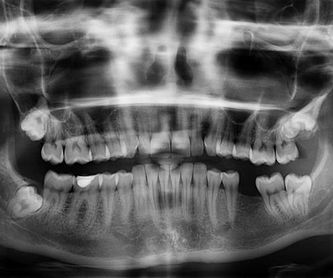 Implantes: Tratamientos dentales de Garrido Palacios, Mª Cruz