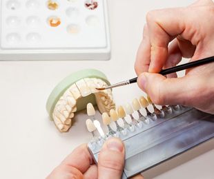 Lo que debes saber de las carillas dentales