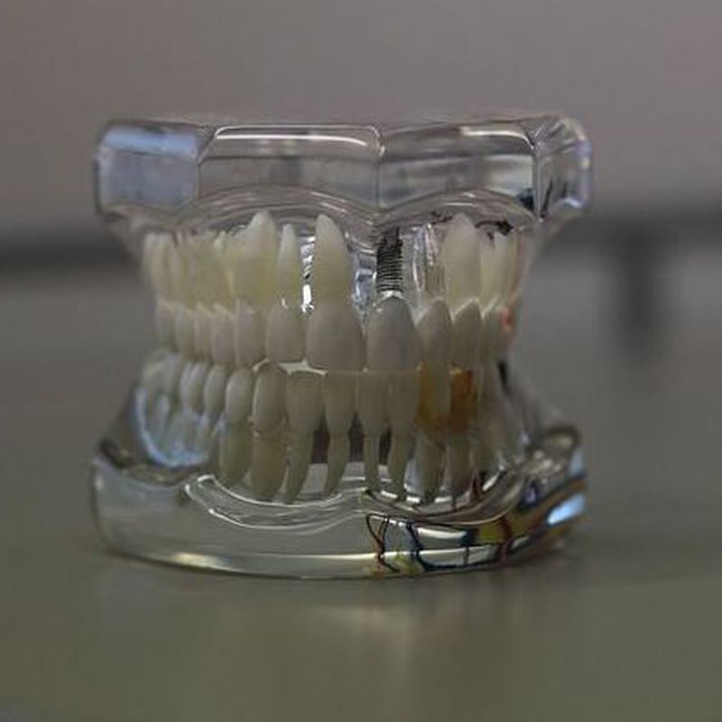 Prótesis fija : Tratamientos de Clínica Dental Herpaden