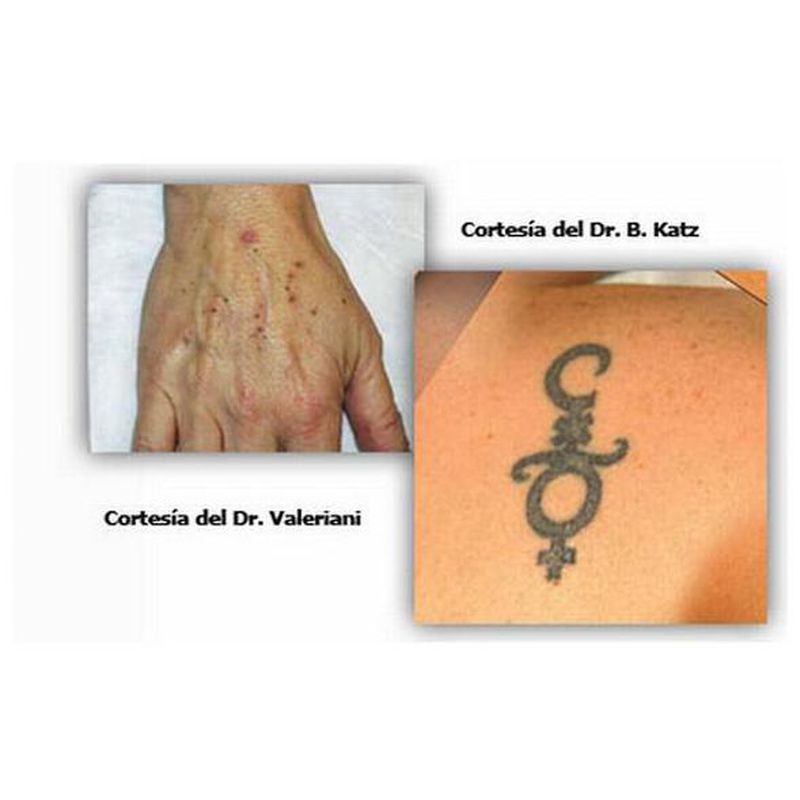 Eliminar tatuaje: Servicios y tratamientos de Dr. Aliaga Clínica Dermatológica