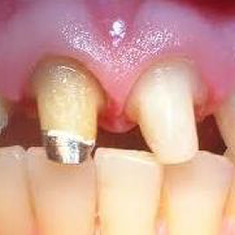 Pernos: Tratamientos de Clínica Dental Tucán