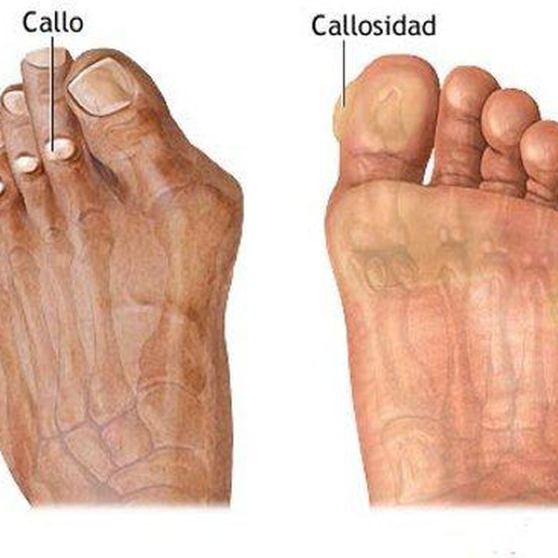 Callosidades: Catálogo de Podocoslada Centro Podológico