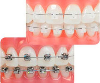 Ortodoncia invisible Invisalign: Tratamientos de Clínica Dental Dra. Carretero