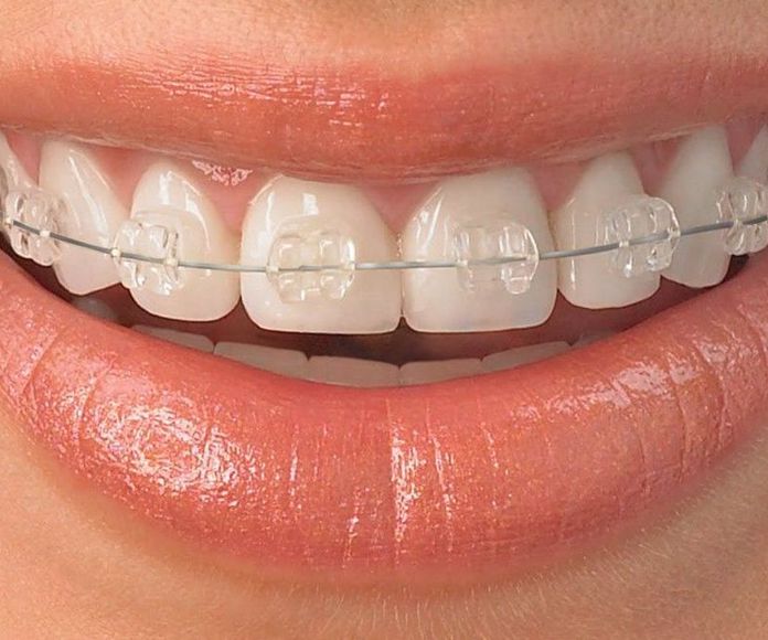 Ortodoncia: Tratamientos de Clínica Dental Fortaña-Giménez