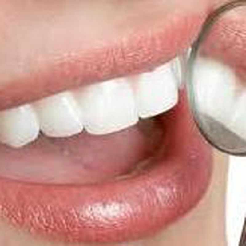 Carillas de composite: Servicios de Clínica Dental Dra. Esther Blánquez