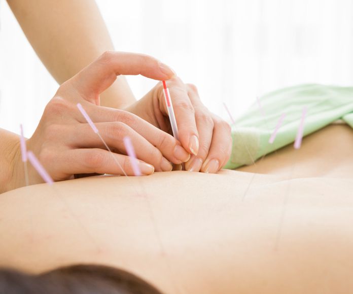 Acupuntura: Servicios de Fisiocentre Salut