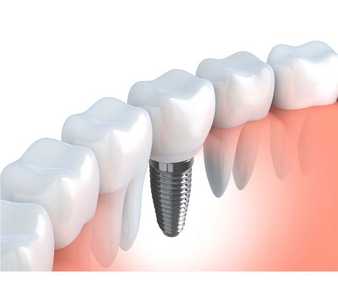 Implantes: Tratamientos dentales de Centro Dental Sant Fost