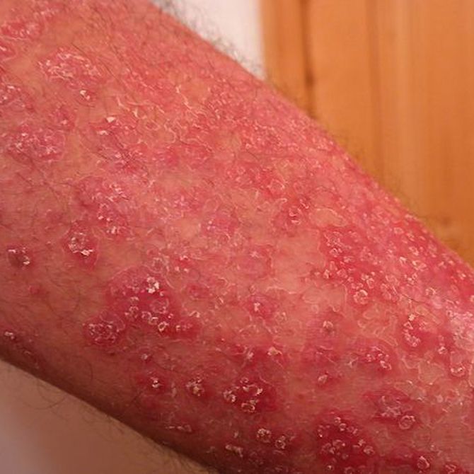 Tratamiento de la dermatitis atópica