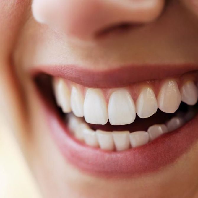 Carillas dentales: económicas, rápidas de colocar y duraderas