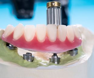 La prótesis dental fija y sus tipos