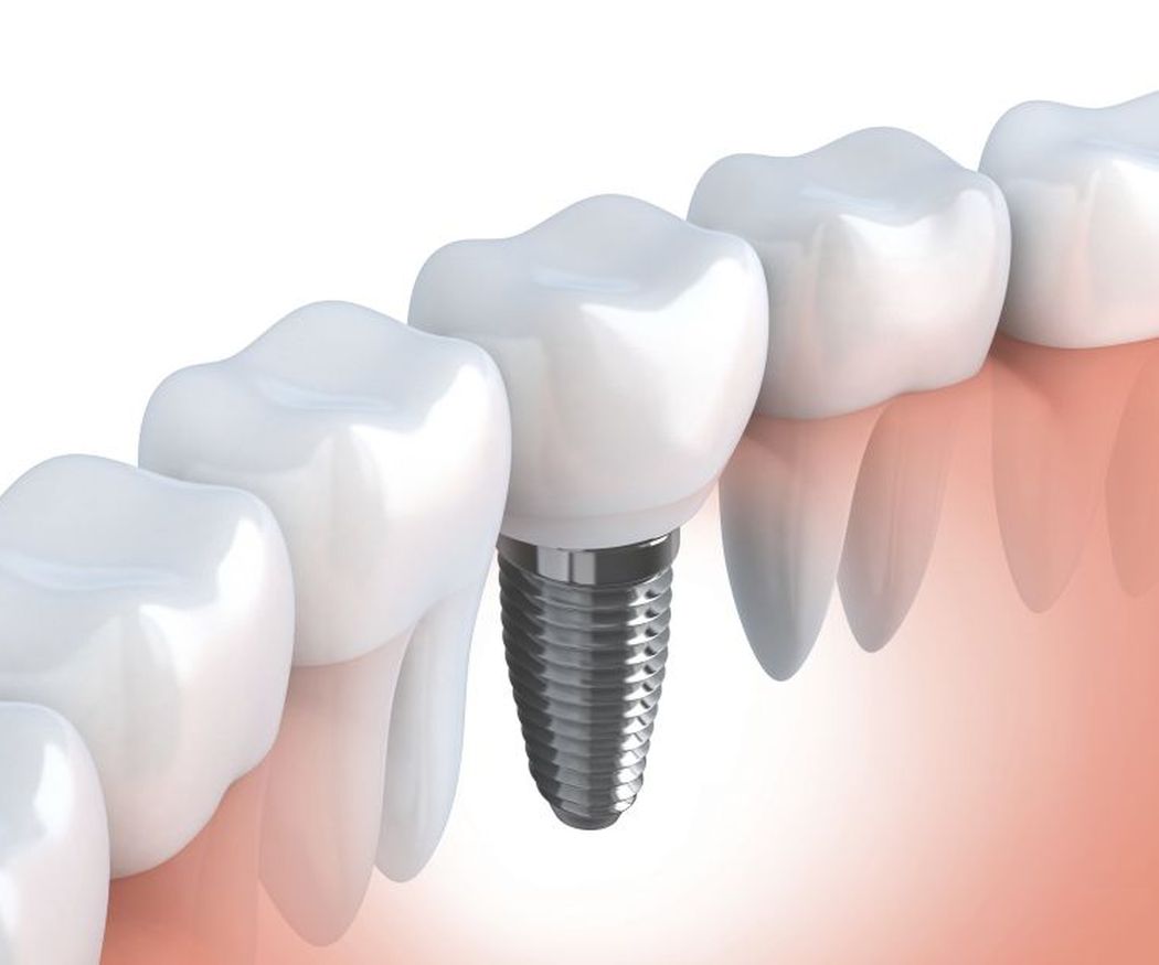 Cuidados tras la colocación de implantes dentales
