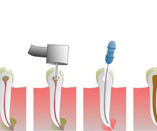 ¿Qué es y por qué hacerse una endodoncia?