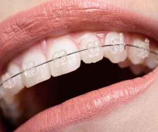 ¿Conoces la ortodoncia autoligable?