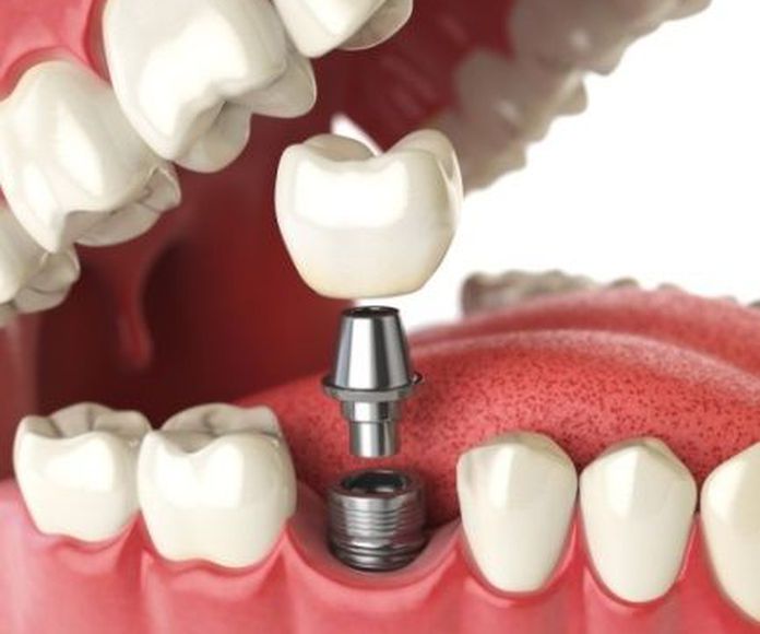 Implantología avanzada: Tratamientos de Clínica Dental Ruiz Jalón