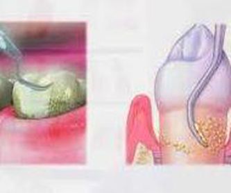 Obturación: Tratamientos de Hospident Clínica Dental