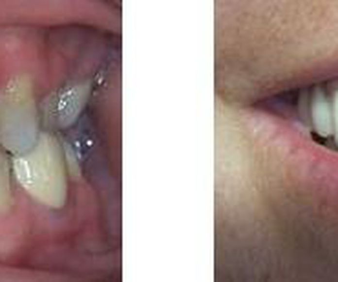 CARILLAS DE COMPOSITE CON TÉCNICA ESTRATIFICADA: Tratamientos de Dental Clínic Palamós