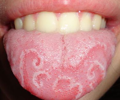 Las enfermedades más habituales de la lengua