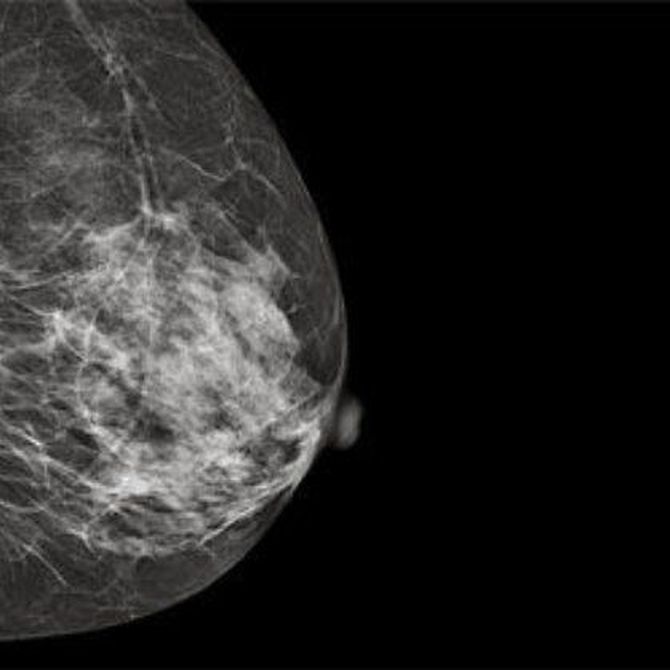 Características y beneficios de las mamografías