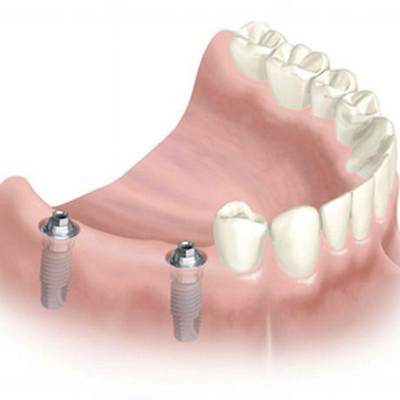 Implantes: Especialidades de Clínica Dental Martín