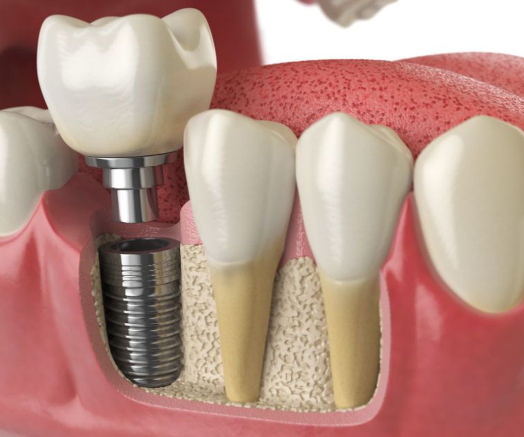 ¿Cómo afecta el tabaco a tus implantes dentales?