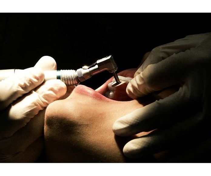 Implantes : Servicios  de Clínica Dental Sanclemente